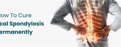 Cervical Spondylosis